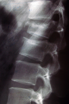 gerincoszlop röntgenképe